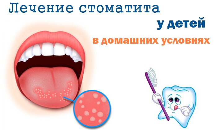 Стоматит на языке у ребенка фото