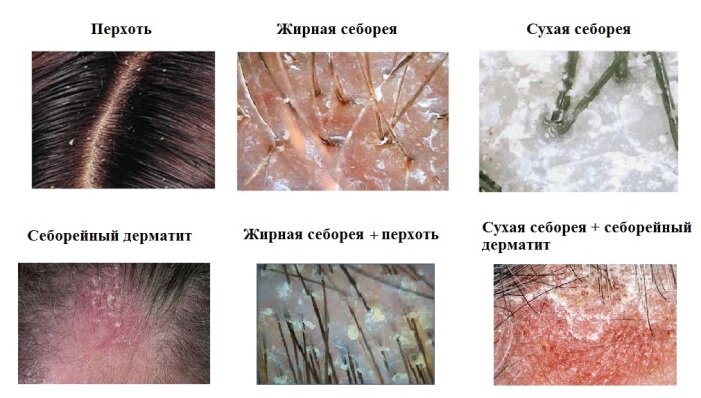 Себорея кожи головы и лица: причины, симптомы, лечение, средства