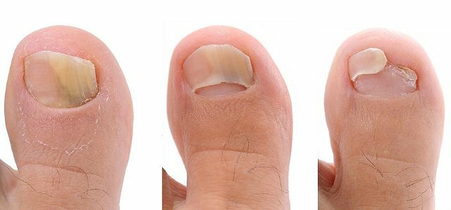 Деформация ногтей на ногах из-за грибка