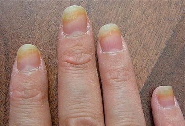 Внешний вид ногтей на руках с грибком