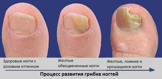 Как развивается грибкок ногтей