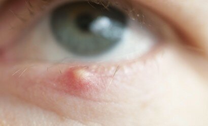 Причины появления и лечение ячменя на глазу