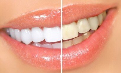 Быстрое отбеливание зубов в домашних условиях