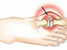 Как лечить или удалить косточку на ноге