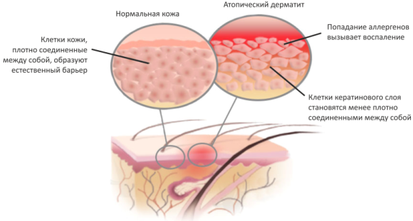 Как возникает атопический дерматит
